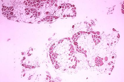 Duchenne spierdystrofie